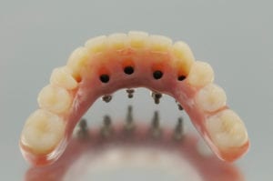 all on four denture in knoxville tennessee