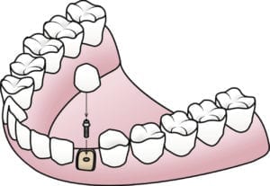 single tooth implant in Hardin Valley Tennessee