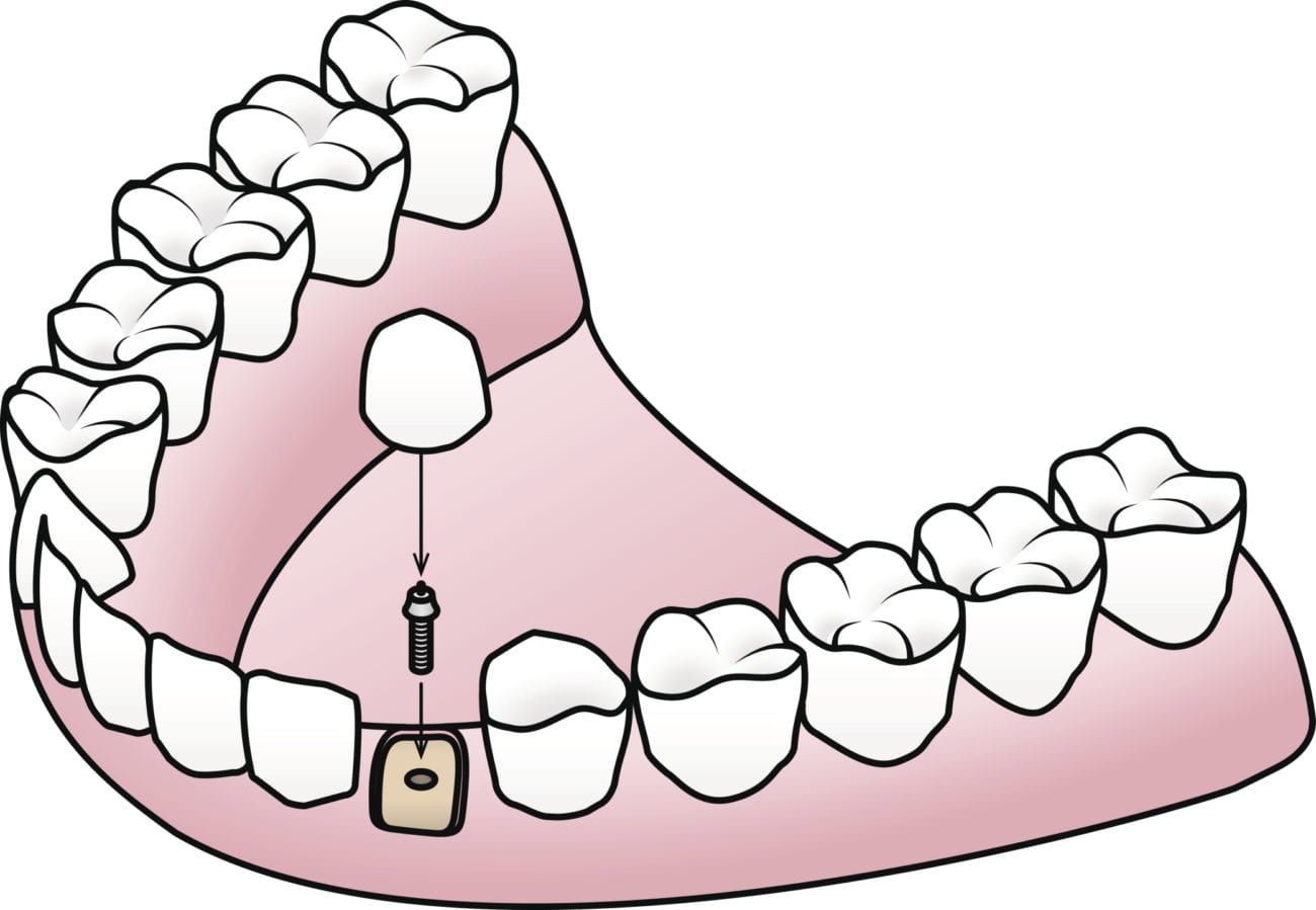 single tooth implant in Hardin Valley Tennessee