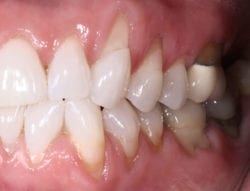 pinhole gum surgery knoxville tn patient before photo