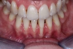 alloderm tissue graft before patient photo