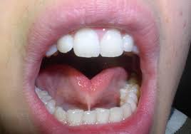 treatment for tongue ties in Hardin Valley Knoxville, TN