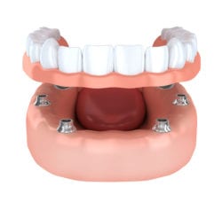 dental implants in Knoxville Tennessee