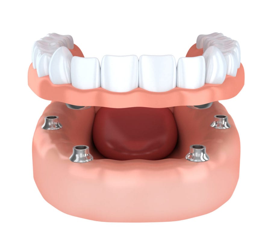 Benefits of Dental Implants Periodontist in Knoxville, TN