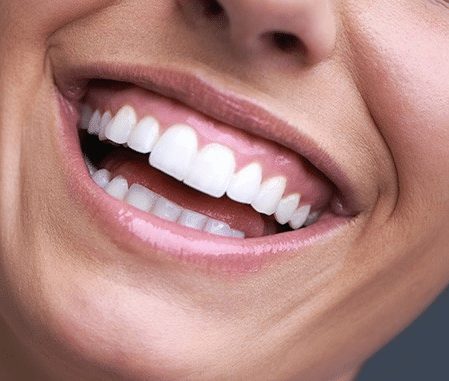 Gummy Smile Treatment in Knoxville TN