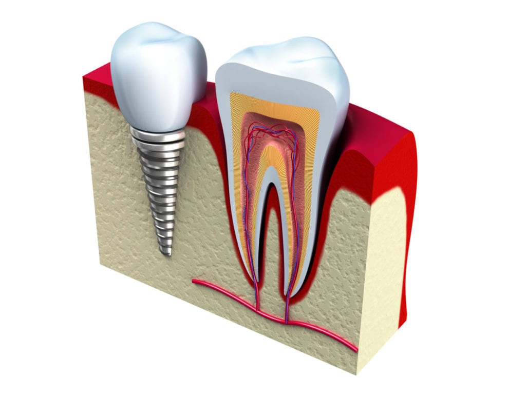 Dental Implants in Maryville TN