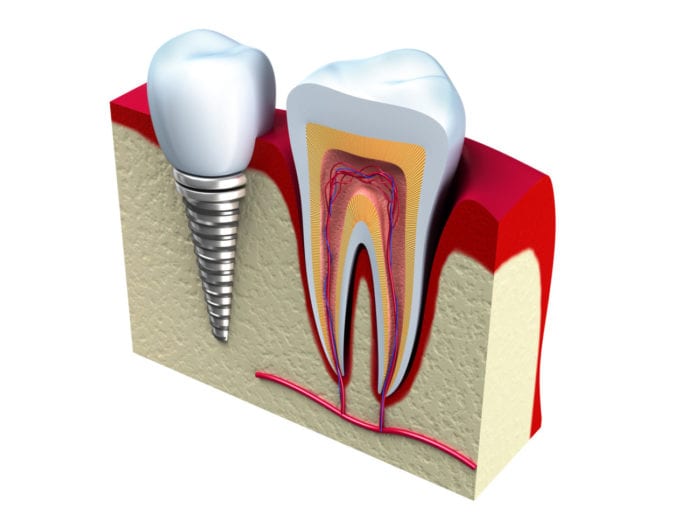 affordable dental implants in Maryville Tennessee