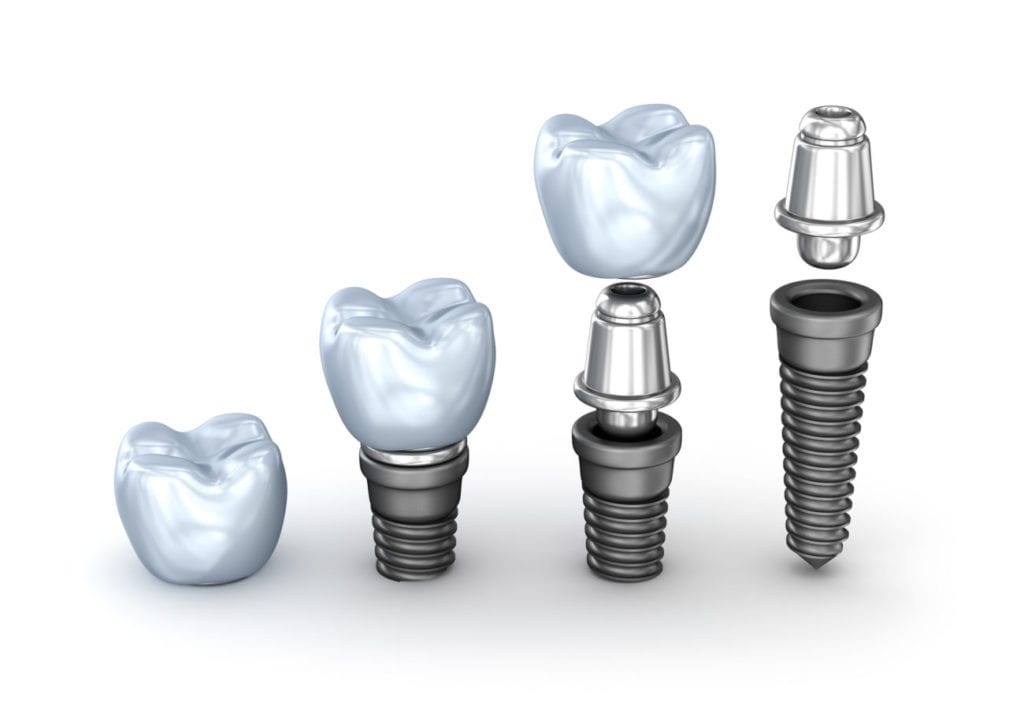 dental implants in Knoxville, Tennessee