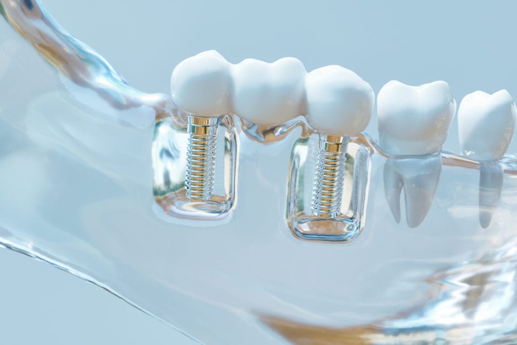 affordable dental implants in Knoxville, Tennessee