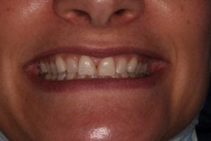 dental black triangles before photo