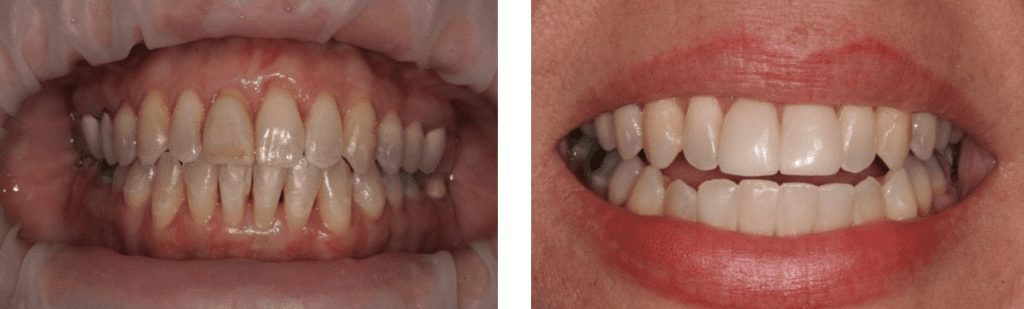 Tooth bonding before and after