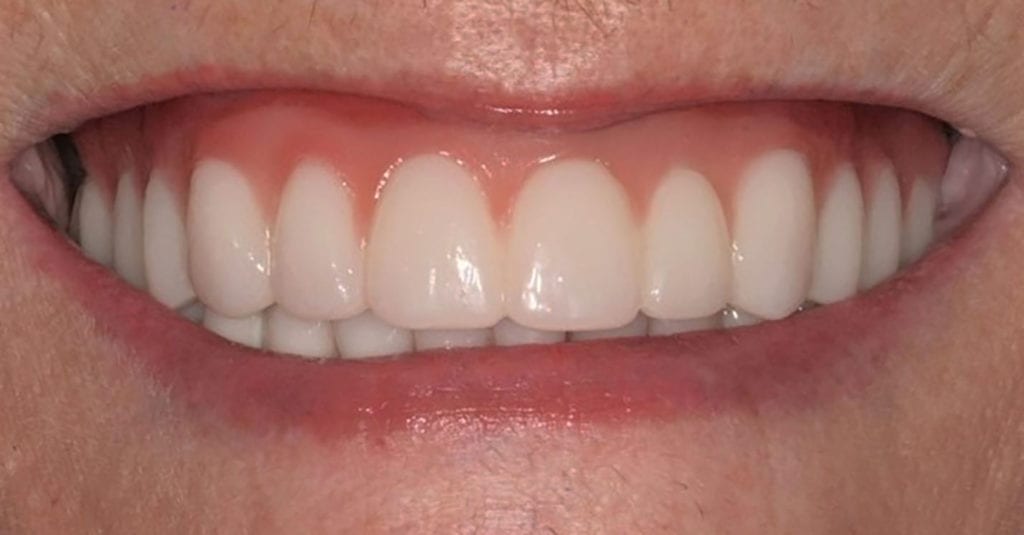 Dentures in Knoxville TN Partial & Implant Dentures