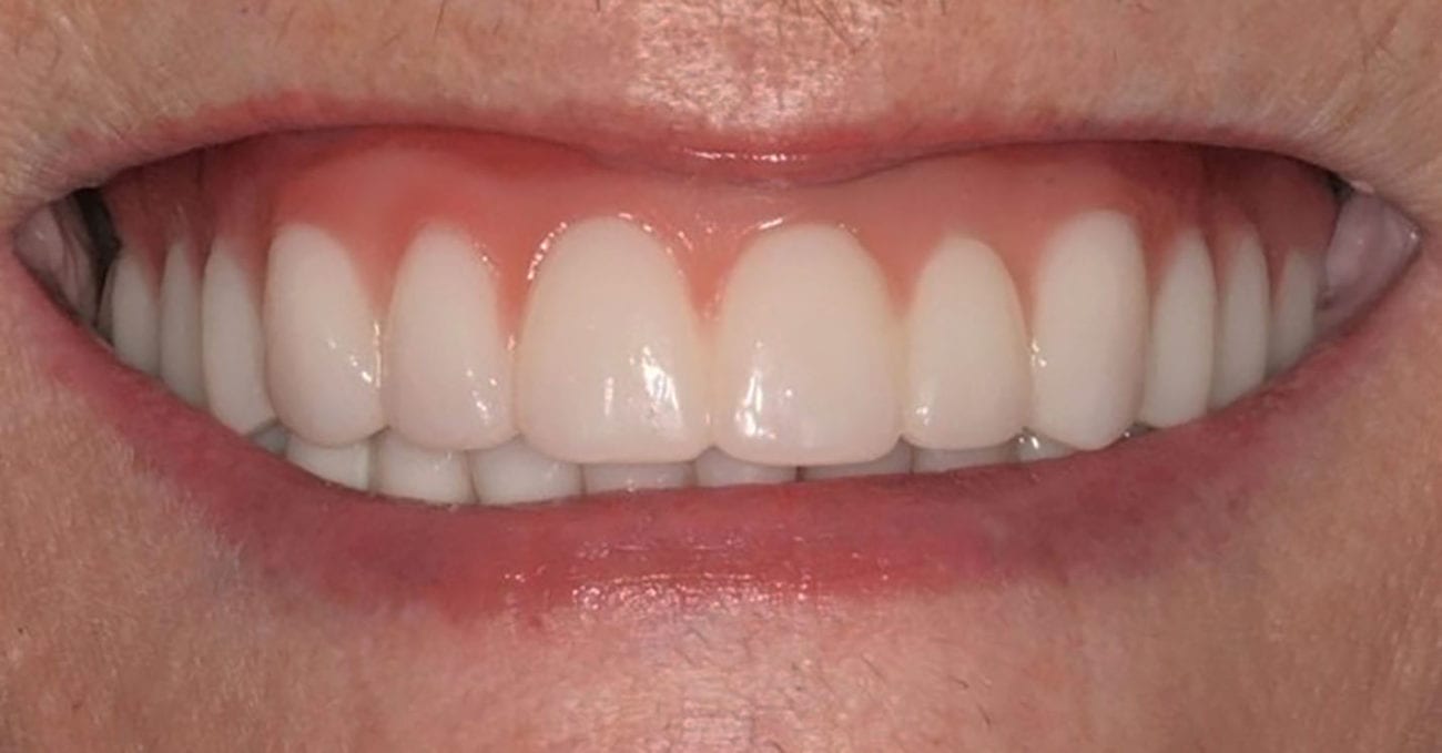 Dentures in Knoxville TN Partial & Implant Dentures
