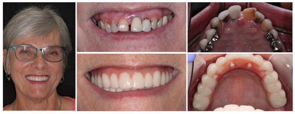 All-on-four implant dentures before and after in Knoxville, TN