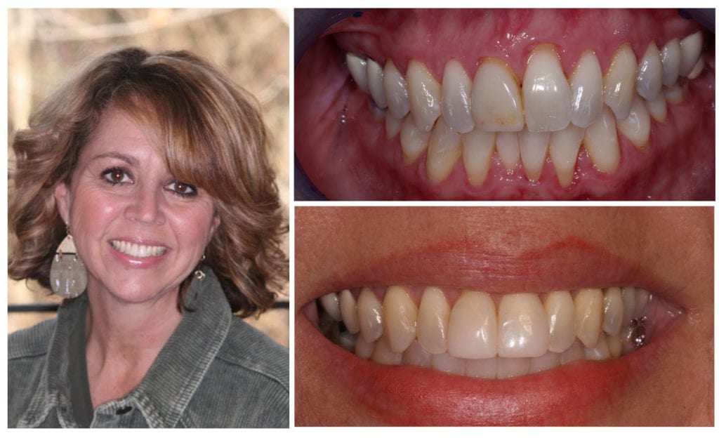 Tooth bonding before and after in Knoxville, TN