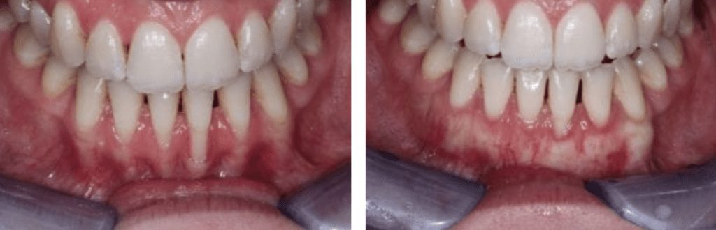 Before and after Soft Tissue Allograft in Knoxville, TN