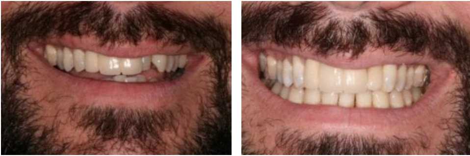 Six Month Smiles before and after in Knoxville, TN