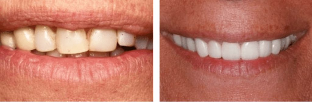 dental crowns before and after in Knoxville, TN