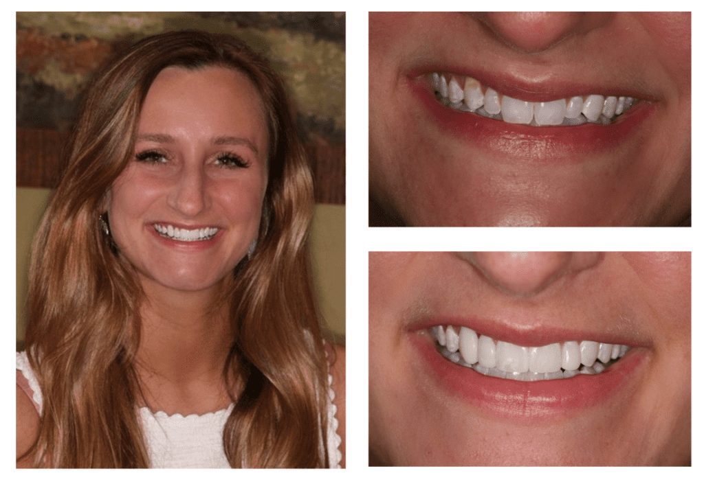Cosmetic dentistry results in Knoxville, Tennessee