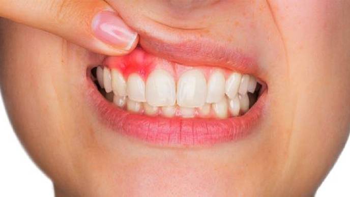 bleeding gums periodontist knoxville tennessee
