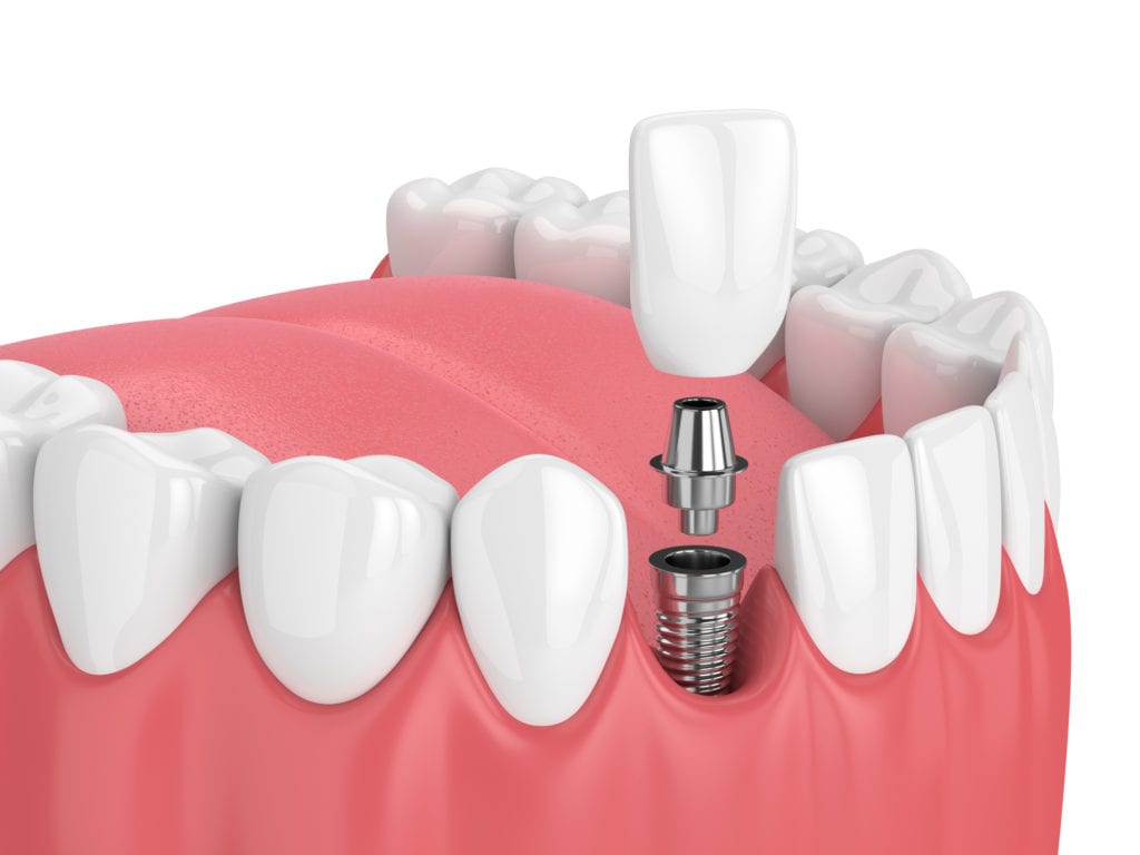 Cost of dental implants in Knoxville, Tennessee