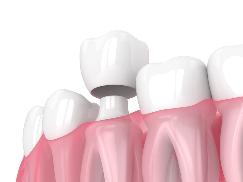 Dental Crowns in Knoxville, Tennessee