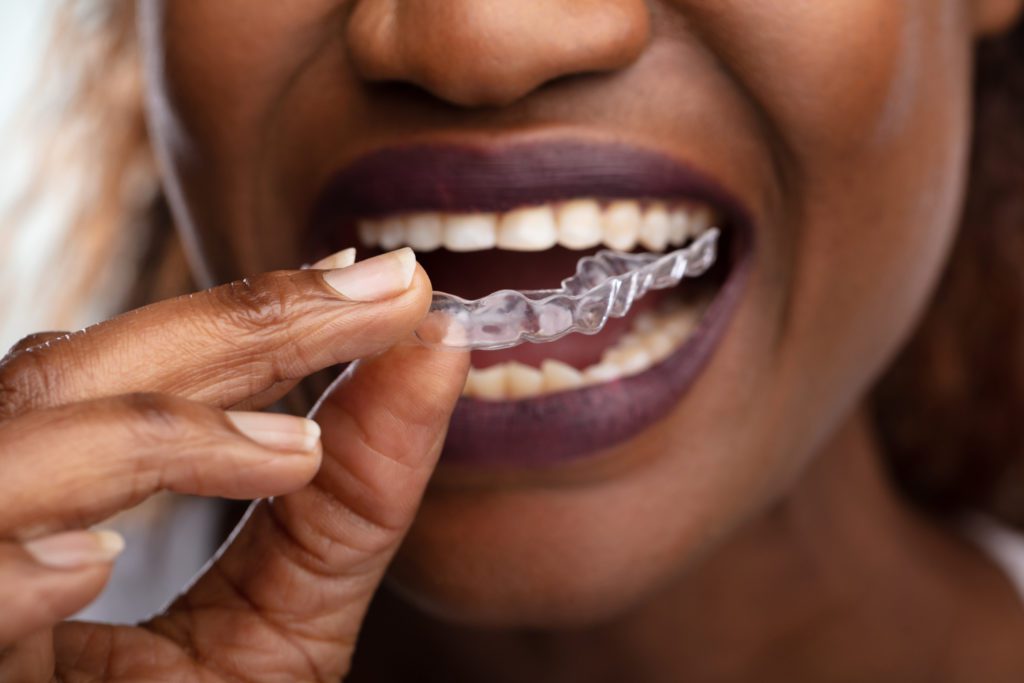 Invisalign vs. Six Month Smiles in Knoxville, Tennessee