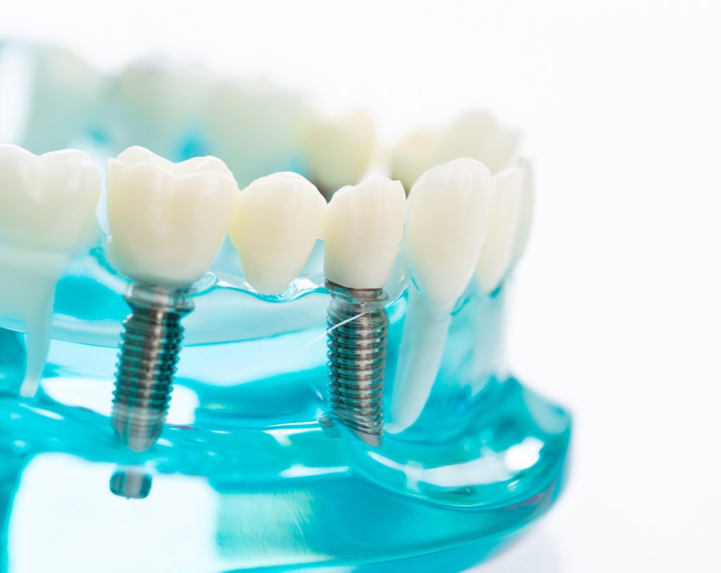 Dental Implants in Knoxville, Tennessee