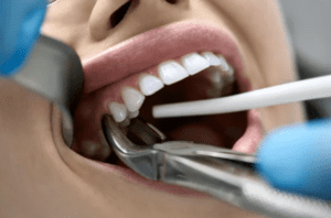 tooth extraction dry socket prevention Knoxville Tennessee