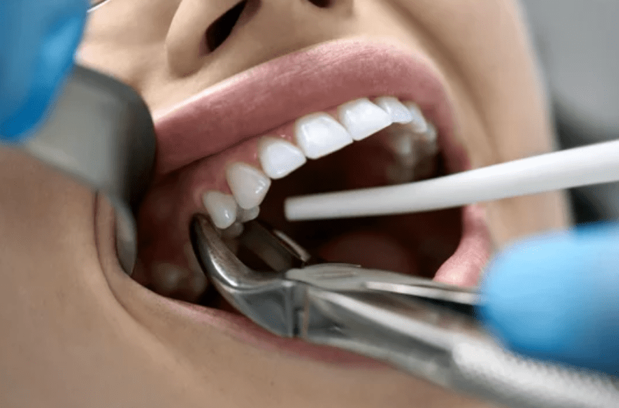 What Is Dry Socket? - Dentists in Knoxville, TN