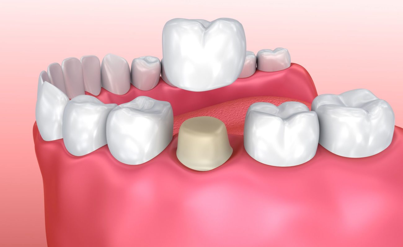 How to Prepare for a Dental Crown Dentist in Knoxville, TN