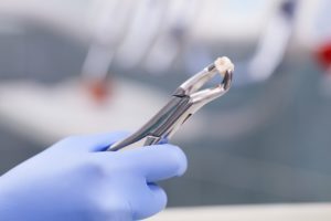 Image of a gloved hand holding forceps with pulled tooth extraction recovery general dentistry dentist in Nashville Tennessee