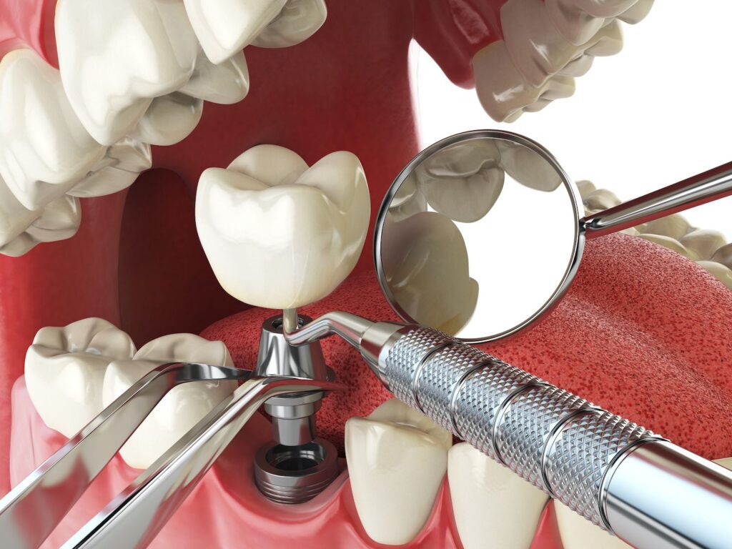 How Gum Disease Affects Implants