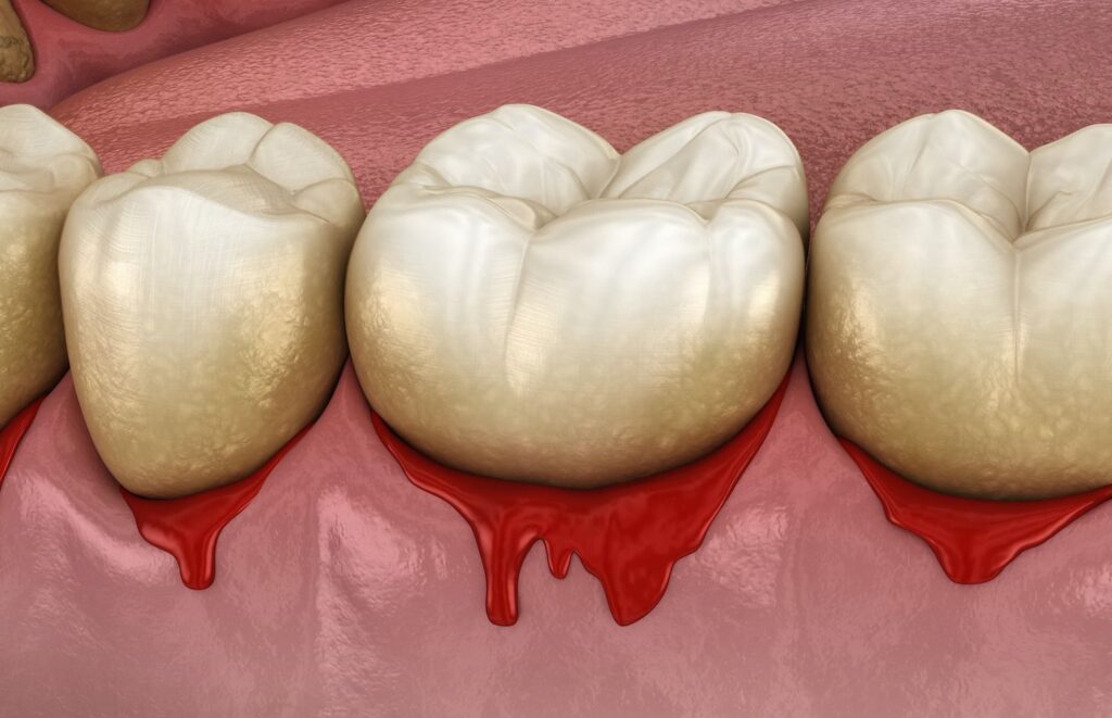 Advanced Gum Disease Effects
