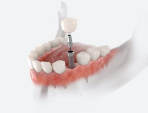 Why Choose Dental Implants for Tooth Restoration in Knoxville, TN